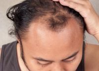 40岁脂溢性脱发怎么办——解决脱发问题的有效方法