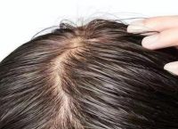 20多岁有秃顶征兆怎么办？保护与修复脱发的完全指南