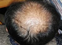 女性脂溢性脱发秃顶的原因和解决办法