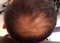怎么应对皮炎脂溢性脱发？