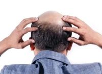 脱发严重是什么原因引起的知乎 - 探索脱发问题背后的因果关系