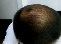 掉发脱发严重是什么原因（防止脱发的最好方法有哪些 知乎）