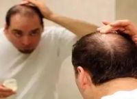 头发油脱发严重是什么原因引起的