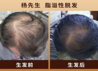 霸王生发液如何促进头发生长和健康