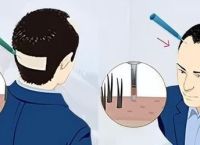 脂溢性脱发是脂溢性皮炎造成的吗怎么办