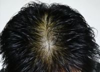 头发长期没吹干导致脂溢性脱发怎么办