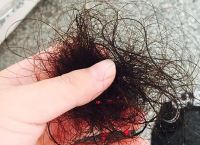 发际线秃顶怎么办？阻止脱发并恢复发际线的有效方法