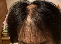 女性脂溢性脱发头发怎么办？专家解读与应对办法