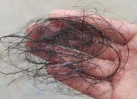 脱发秃发严重是什么原因引起的？