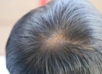如何防止脱发与头皮屑增多有关系的方法