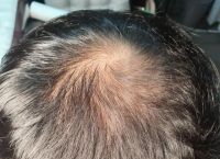 斑状脱发是什么原因引起的