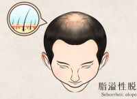 女性有秃顶基因怎么办？探索克服秃顶困扰的方法