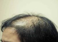 更年期掉头发正常吗？如何改善更年期脱发？