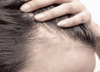 脱发断发严重是什么原因引起的？