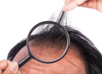 脂溢性脱发脂溢性脱发怎么办？解决方案和预防措施
