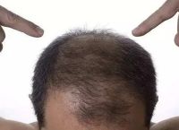 经期脱发是什么原因引起的？