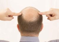 秃顶问题解决方案：两侧秃顶怎么办？