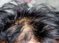头发出油脱发严重是什么原因，头发爱出油怎么办改善？