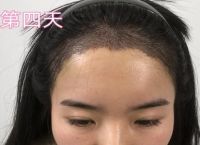 植发靠谱吗，植发技术中国现在成熟了吗？