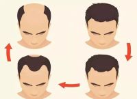 脂溢性脱发有后期才表现出来的吗怎么办