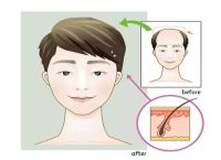 脱发秃顶了怎么办脂溢性脱发的治疗方法和预防措施