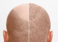 脂溢性脱发重新长出来的细软头发怎么办