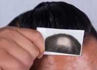 男人秃顶严重影响外观该怎么办