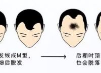 如何防止辐射引起脱发
