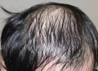 慢性脂溢性脱发还能长出来吗？
