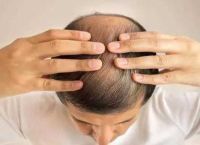 脱发严重是什么原因引起的？头发严重脱发怎么补救？