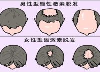 脱发的几种类型和原因，中医调理可逆转脱发！