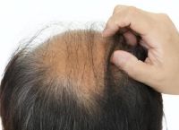 掉发脱发严重是什么原因？预防脱发的方法有哪些？
