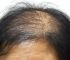 什么是雄性激素脱发​？雄激素性脱发怎么治？