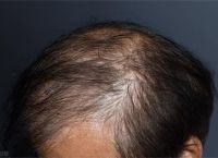 什么是雄性激素脱发？治疗脱发的方法有哪几种？