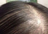 什么是雄激素性脱发？雄激素性脱发怎么调理？
