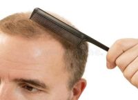 脱发线索：请问脱发是什么原因引起的？