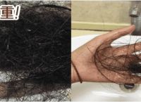 皮炎脱发是什么引起的原因？详细解析病因及预防方法