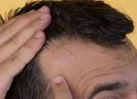 解析严重的失眠脱发是什么原因引起的
