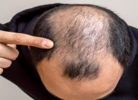 如何治疗脱发？雄激素性脱发的治疗方法！