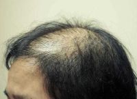 螨虫脱发是什么原因引起的