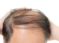 什么是雄性激素脱发怎么治疗？