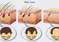 植发手术有风险吗？哪些人适合植发？