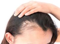 头发出油脱发是什么原因引起的？