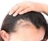 头发出油脱发是什么原因引起的？