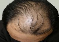 脱发中医辨证论治处方（脂溢性脱发）