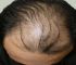 脱发中医辨证论治处方（脂溢性脱发）