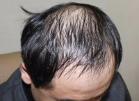 脂溢性脱发，头容易出油脱发怎么办？