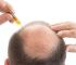 如何避免脱发秃顶？如何预防脱发？