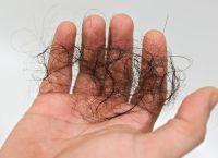 鬓角脱发是什么原因引起的