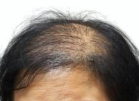 老年女性如何防止脱发